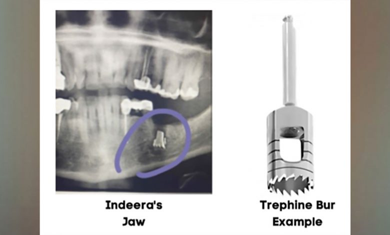 Texas Woman Sues Oral Surgeon After Metal Drill Bit Left Inside Her Jaw – CBS Dallas / Fort Worth