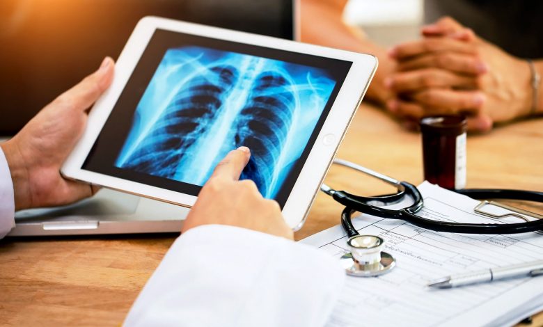 Targeted High-Dose Radiation Helps Fight Advanced Lung Cancer