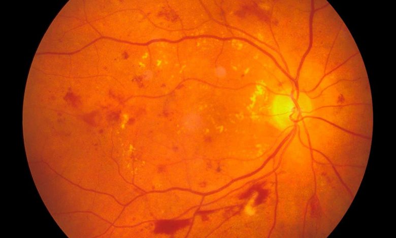 Retinopathy: NHS trial will test AI diagnosis with eye scans from 150,000 patients