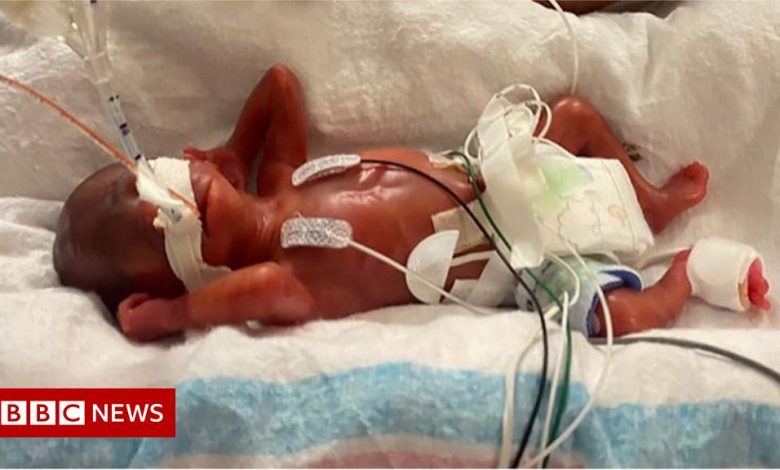 Alabama boy certified as world's most premature baby