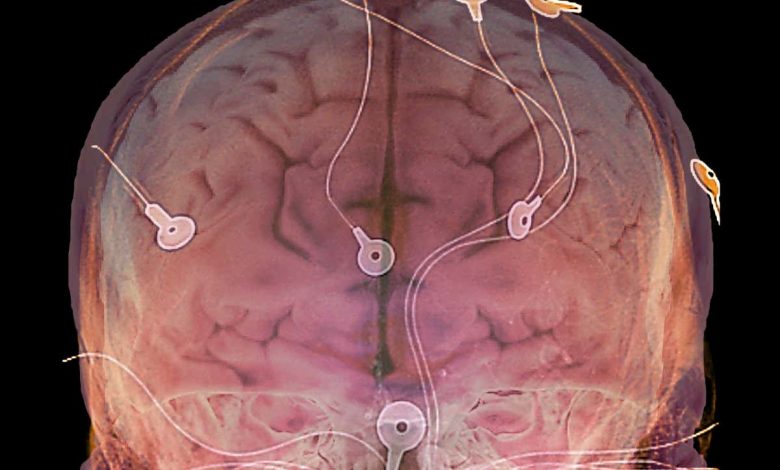 Brain implants: Electrical stimulation boosts ability to think flexibly