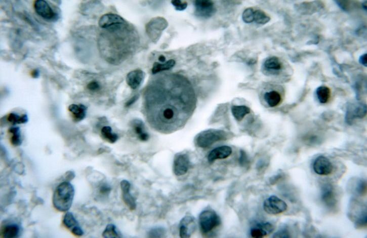 Naegleria fowleri, known as a "brain-eating amoeba", pictured here residing in a brain tissue.