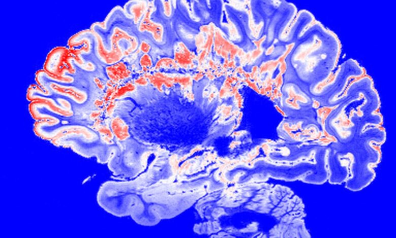 This is a pseudo-colored image of high-resolution gradient-echo MRI scan of a fixed cerebral hemisphere from a person with multiple sclerosis. Image credit: Govind Bhagavatheeshwaran, Daniel Reich, National Institute of Neurological Disorders and Stroke, National Institutes of Health, Public Domain