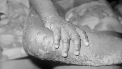 WHO names monkeypox a public health emergency, over 15,000 cases globally