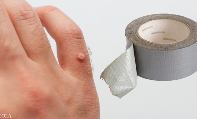 How to remove warts with duct tape