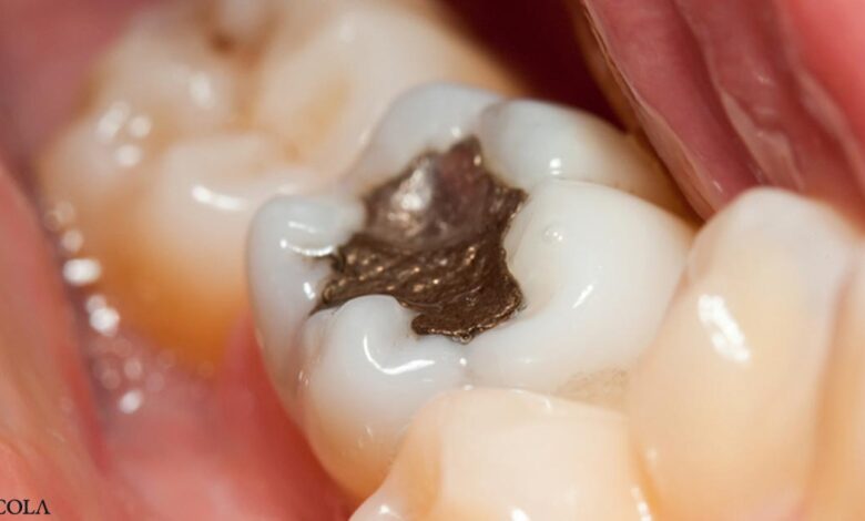 Movement to prevent mercury in dentistry gaining momentum