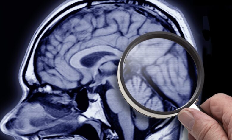 Obesity linked to Alzheimer's-like changes in the brain