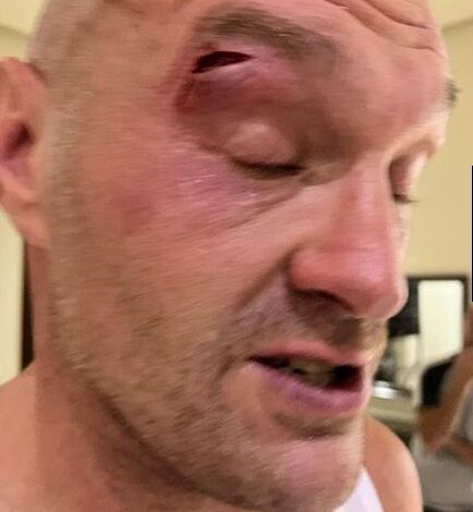 Tyson Fury Cut Badly, Oleksandr Usyk Fight Postponed