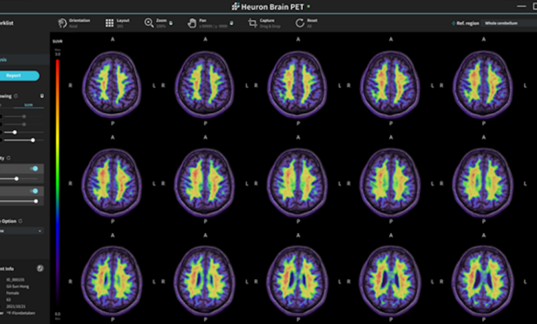 National University Hospital tests AI that predicts Alzheimer's disease diagnosis and more AI briefs